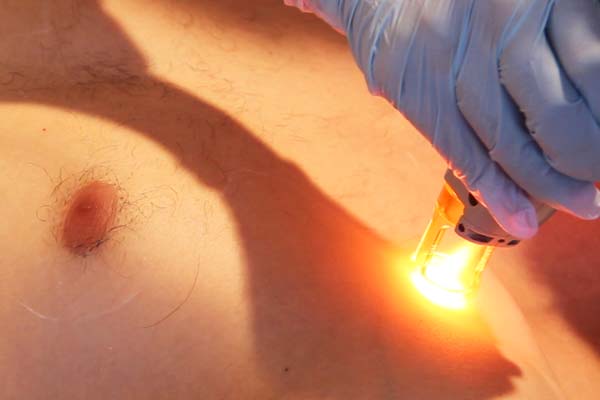 Dunkle Haare können mit dem Neodym-Laser dauerhaft entfernt werden.