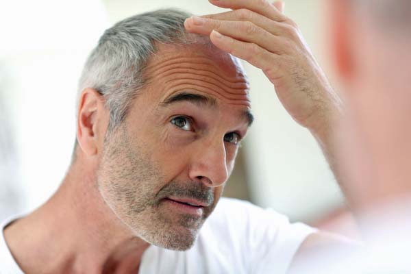 Bei Haarausfall kann oft nur noch eine Haartransplantation helfen.