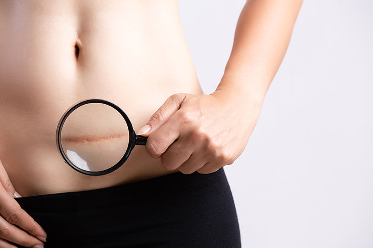 Auffällige Unfall- oder Operations-Narben (hier: Kaiserschnitt-Narbe) kann der Hautarzt in den meisten Fällen durch eine Laser-Behandlung deutlich reduzieren.
