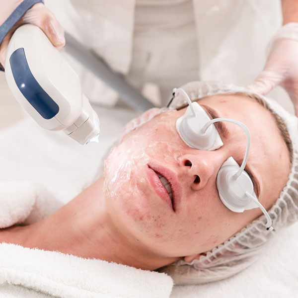 Akne kann der Hautarzt effizient mit dem medizinischen Laser behandeln