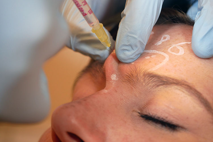 Falten Behandlung Mit Botox Beim Hautarzt In Kiel Hautarztzentrum Kiel