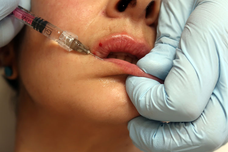 Durch eine Hyaluron-Injektion kann der Hautarzt schmalen Lippen Schwung verleihen.
