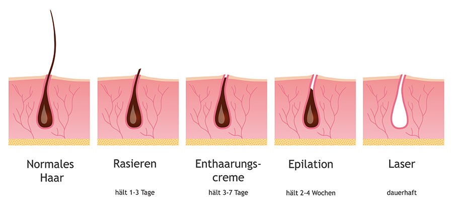 Die Methoden der Haarentfernung sind vielfältig - von der Rasur bis zum Waxing. Am nachhaltigsten kann es der Hautarzt mit dem Laser.