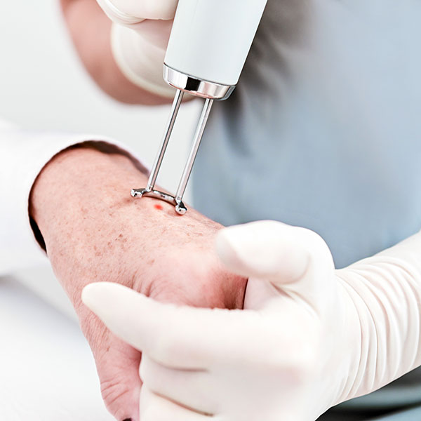 Hautkrebs-Vorstufen (Aktinische Keratosen) werden vom Hautarzt mit dem Laser entfernt