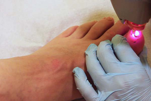 Fußpilz und Nagelpilz können mit medizinischen Lasern behandelt werden