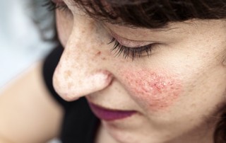 Rosacea entsteht durch erweiterte Adern unter der Haut. Erfolgreich behandeln kann der Hautarzt sie mit dem medizinischen Laser.