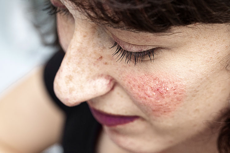 Rosacea entsteht durch erweiterte Adern unter der Haut. Erfolgreich behandeln kann der Hautarzt sie mit dem medizinischen Laser.