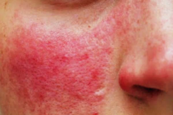 Rosacea Behandlung Beim Hautarzt In Kiel Hautarztzentrum Kiel