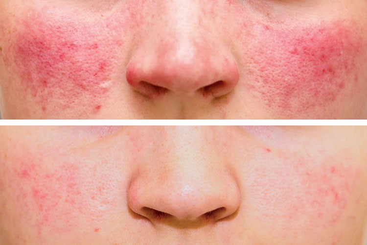 Mit einer Laser-Behandlung kann der Hautarzt die Rosacea-Symptome deutlich verbessern. (hier: Vorher-Nachher-Bilder einer Behandlung im Hautarzt-Zentrum Kiel 2013.)