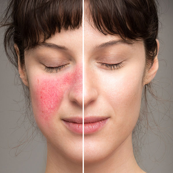 Hautrötungen durch Rosacea/Couperose kann der Hautarzt mit dem Laser verbessern