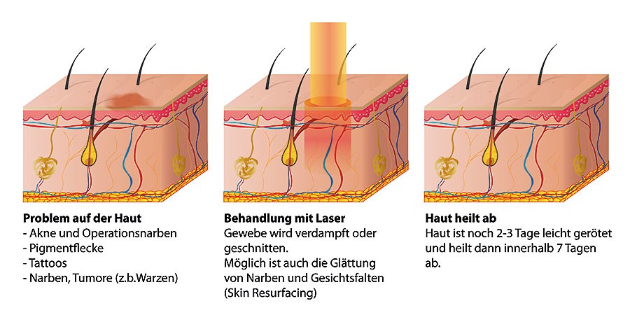 Falten und andere Hautprobleme können mit dem Laser Skin Resurfacing behandelt werden.