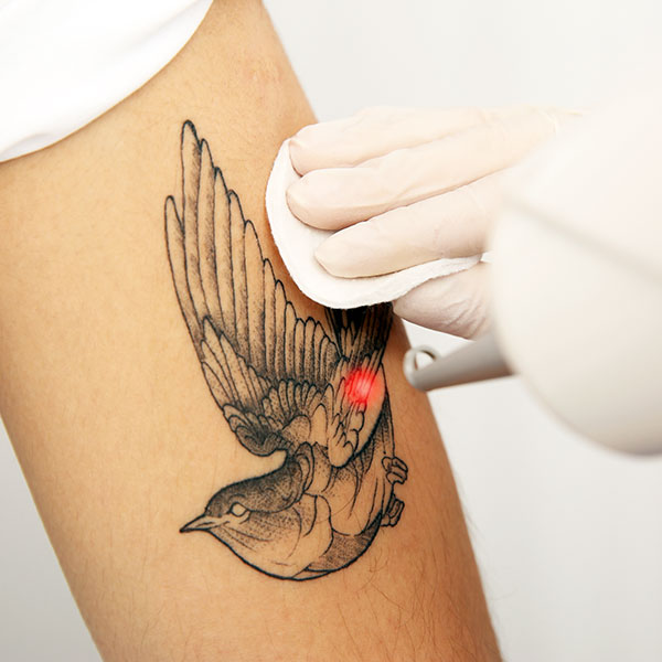 Eine Tattooentfernung beim Hautarzt mit dem Laser ist meist die schonendste Möglichkeit, Tätowierungen loszuwerden